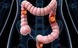 结直肠癌类器官