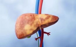 代谢相关脂肪性肝炎(MASH)模型构建